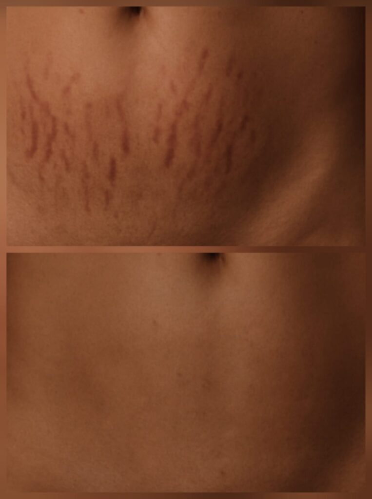 Zdravljenje brazgotin in strij