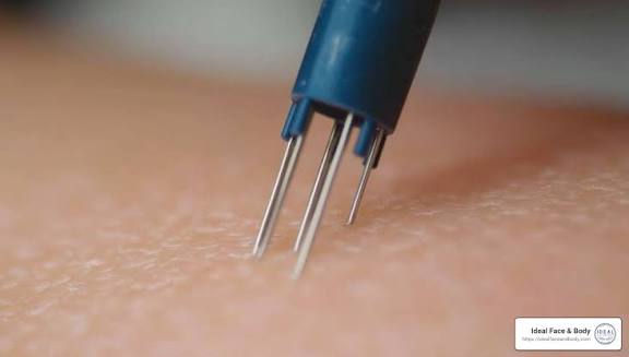 Zdravljenje brazgotin in strij