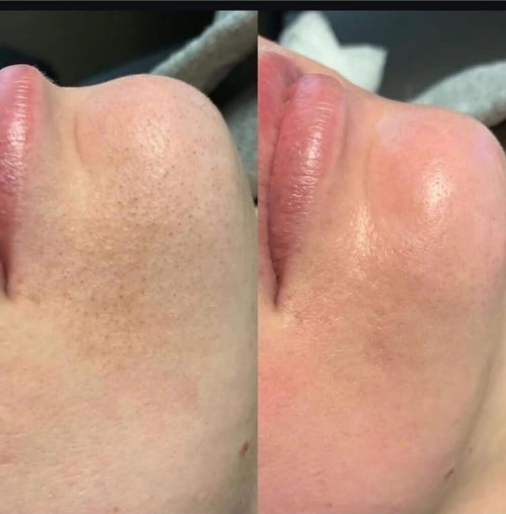 HydraFacial Glass Facial