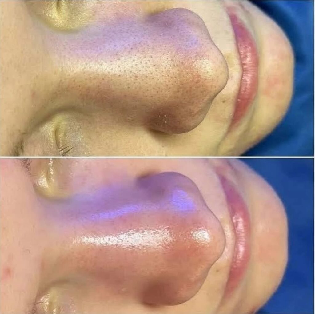 HydraFacial Glass Facial