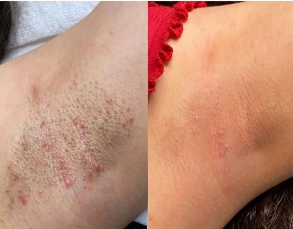 lasersko odstranjevanje dlačic